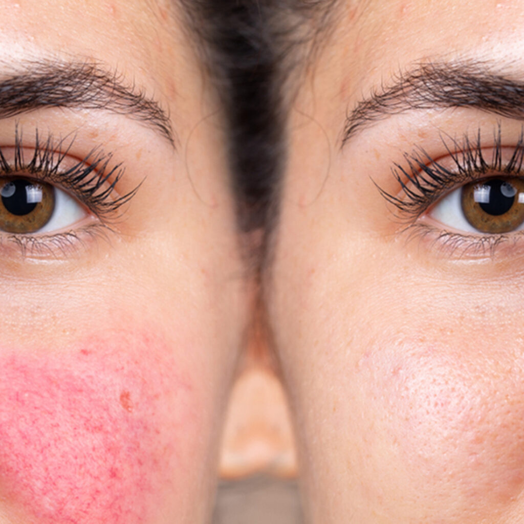rosacea